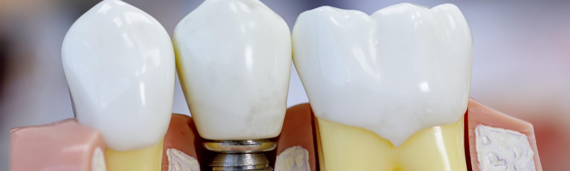 Single Tooth Implants Torrance CA