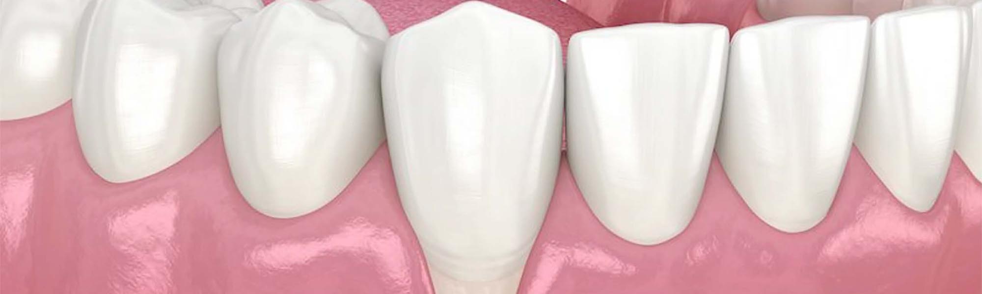 Soft Tissue Grafting Torrance CA