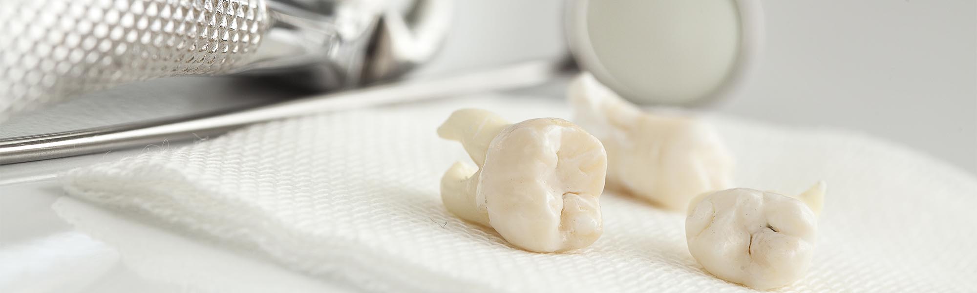 Wisdom Tooth Removal in Torrance CA